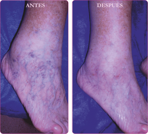 Tratamiento varices 04